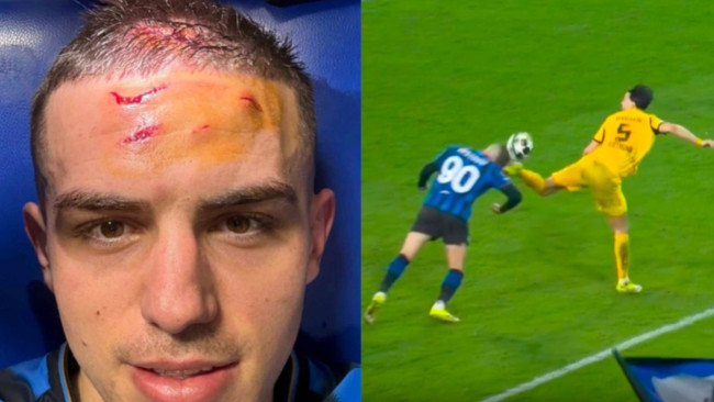 Nikola Krstović dell'Atalanta mostra la fronte dopo un drammatico rigore all'ultimo minuto contro il BVB